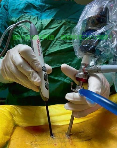 揭秘骨科VPS手术，细节、要点一网打尽！ 第2张